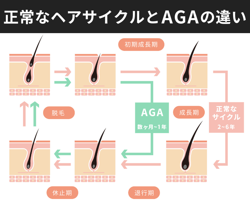 正常なヘアサイクルとAGAとの違いの図