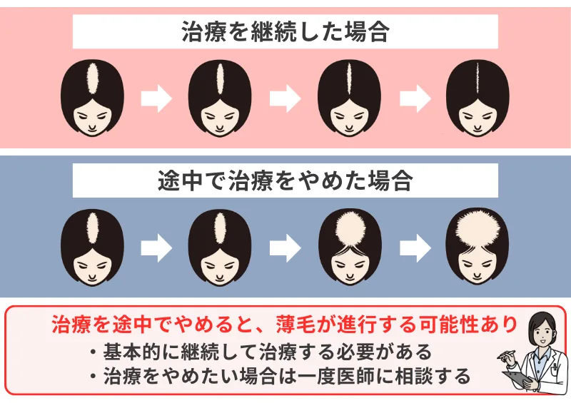 女性-薄毛治療-途中でやめる-どうなる