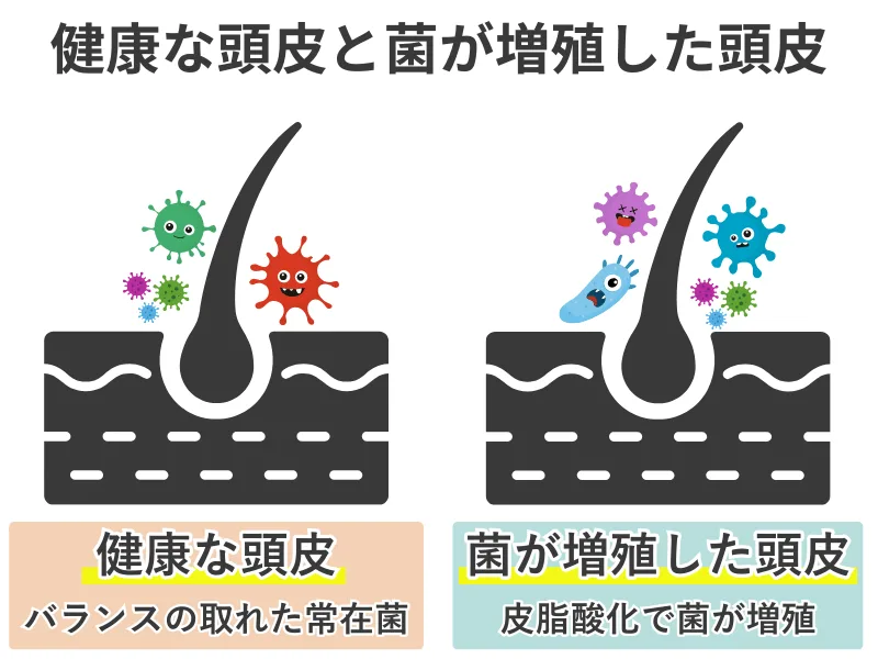健康な頭皮と皮脂酸化による菌バランス崩れの比較図
