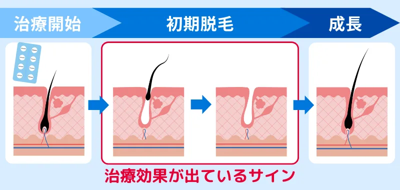 AGAの初期脱毛の進行具合をまとめたフロー図