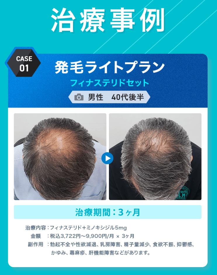 DMMオンラインクリニックAGA治療の事例ケース1。発毛ライトプランに含まれるミノキシジルの効果が期待できることが分かる画像