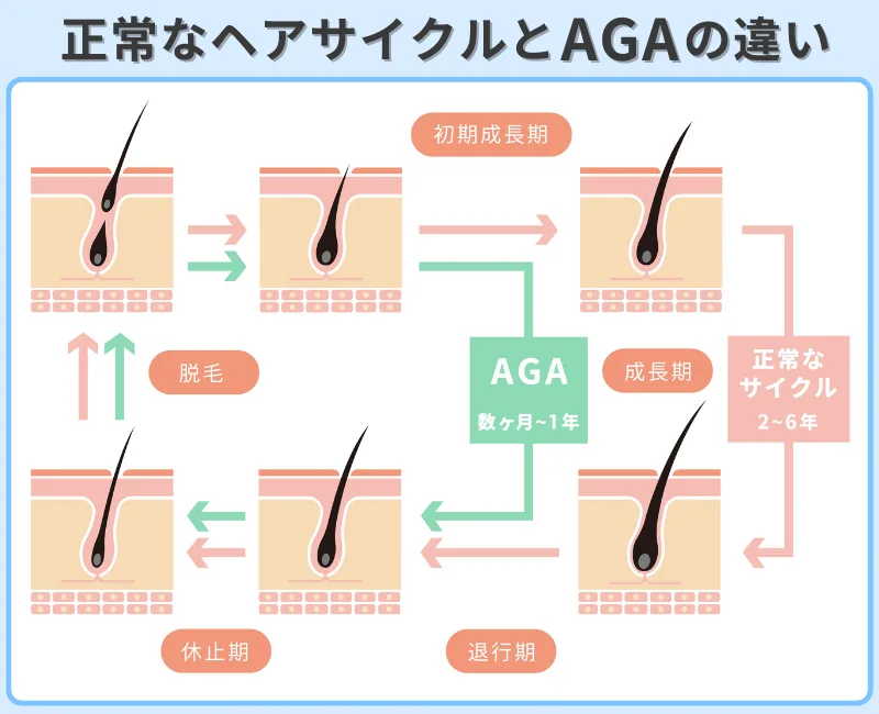 正常なヘアサイクルとAGAの違いを表したフロー図