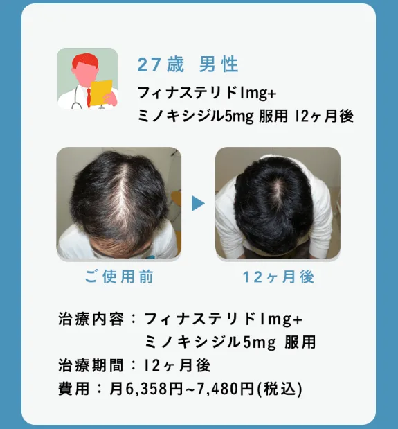 OopsHAIR-効果-ビフォーアフター画像2
