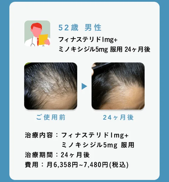 OopsHAIR-効果-ビフォーアフター画像3