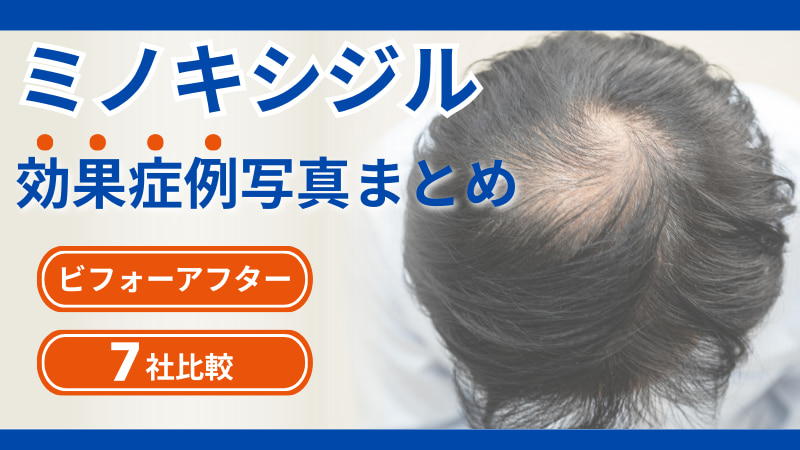 ミノキシジルの効果症例写真まとめ｜ビフォーアフターで分かる期間の目安のアイキャッチ画像
