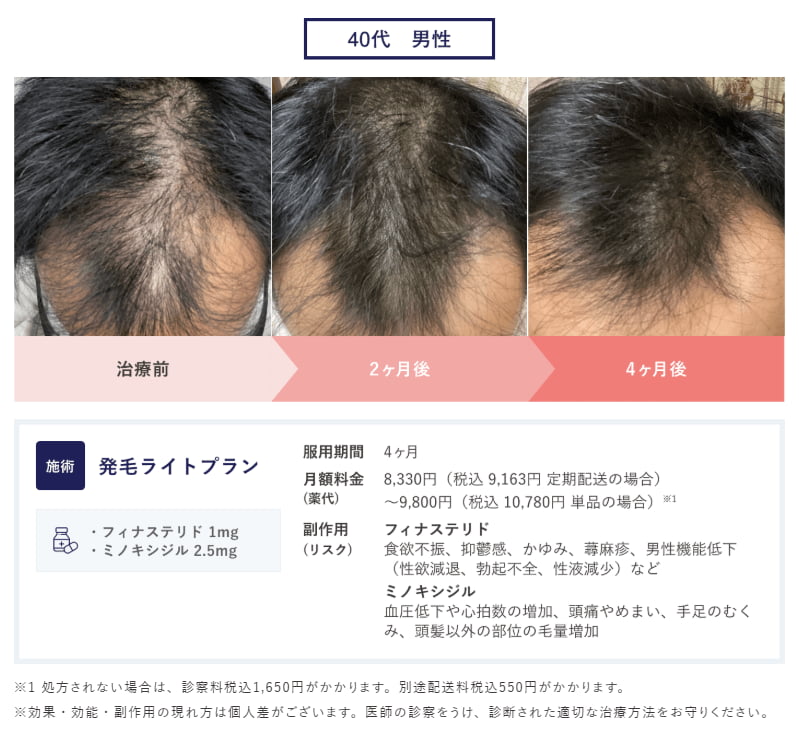 クリニックフォアのミノキシジル内服を含む治療症例(服用2ヶ月、4ヶ月)。頭頂部、生え際と全体的に進んでいた薄毛が、徐々に黒々しく戻っていくビフォーアフター比較画像。