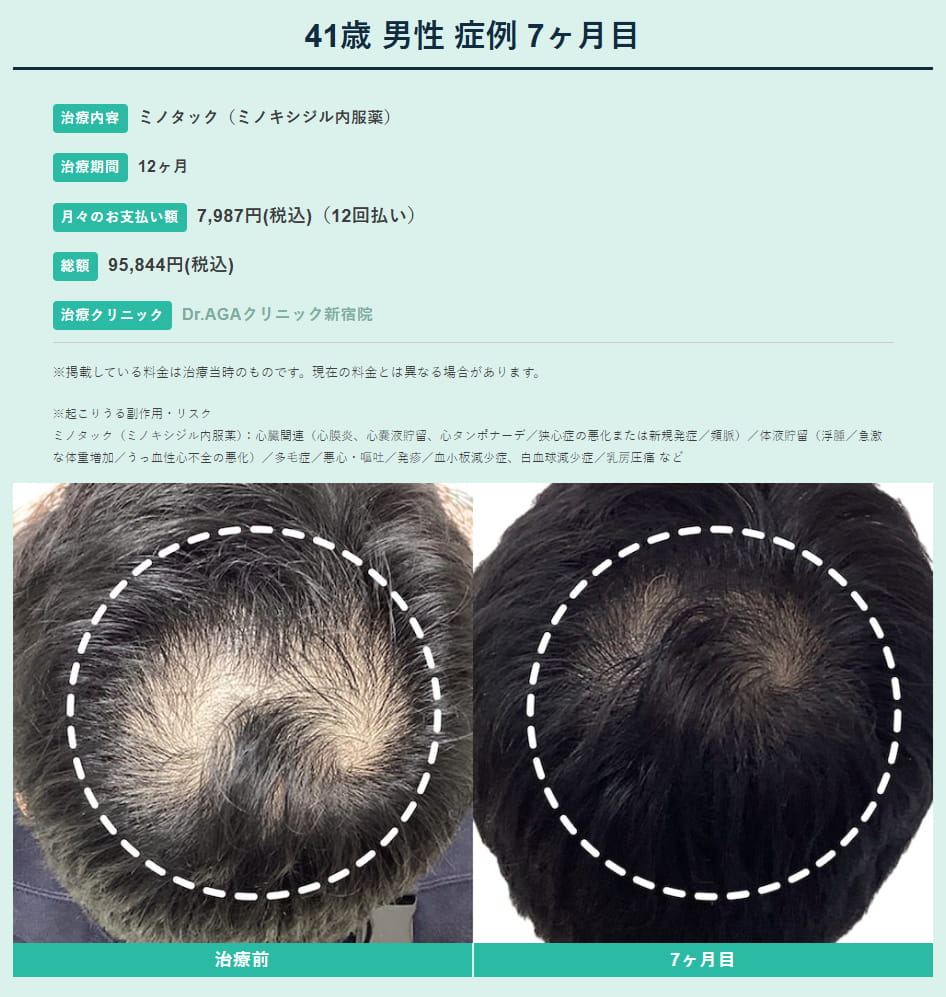 Dr.AGAクリニックのミノキシジル単剤処方による発毛症例写真(服用7ヶ月)。頭頂部の細く軟毛化していた髪が太く成長し、毛髪のコシと密度が改善している比較。