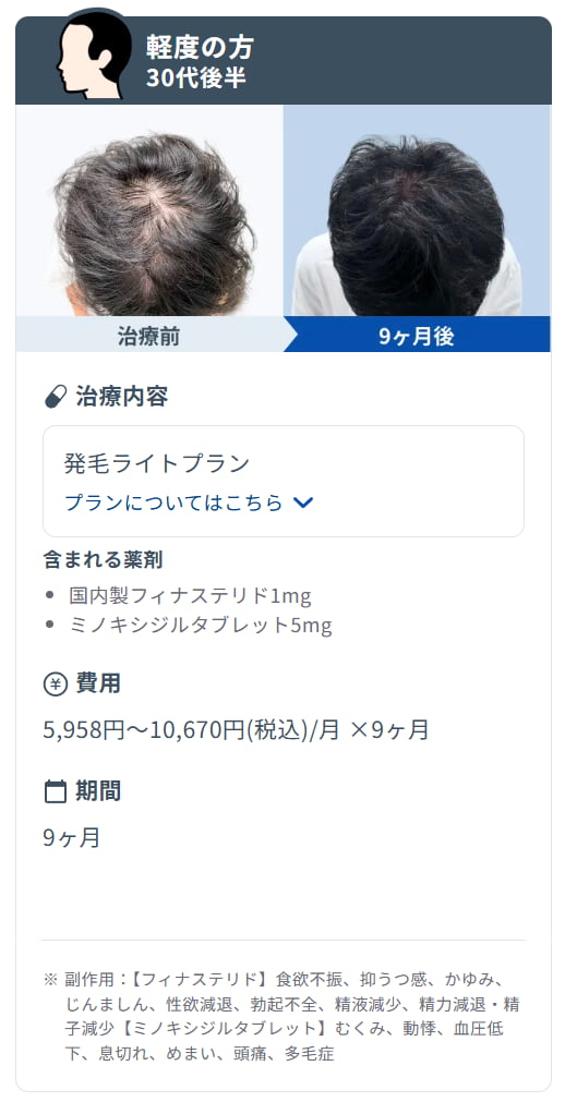 DMMオンラインクリニックのミノキシジル内服治療による症例写真(服用9ヶ月)。頭頂部(つむじ)の密度が改善し、地肌の露出が減っているビフォーアフターの様子。