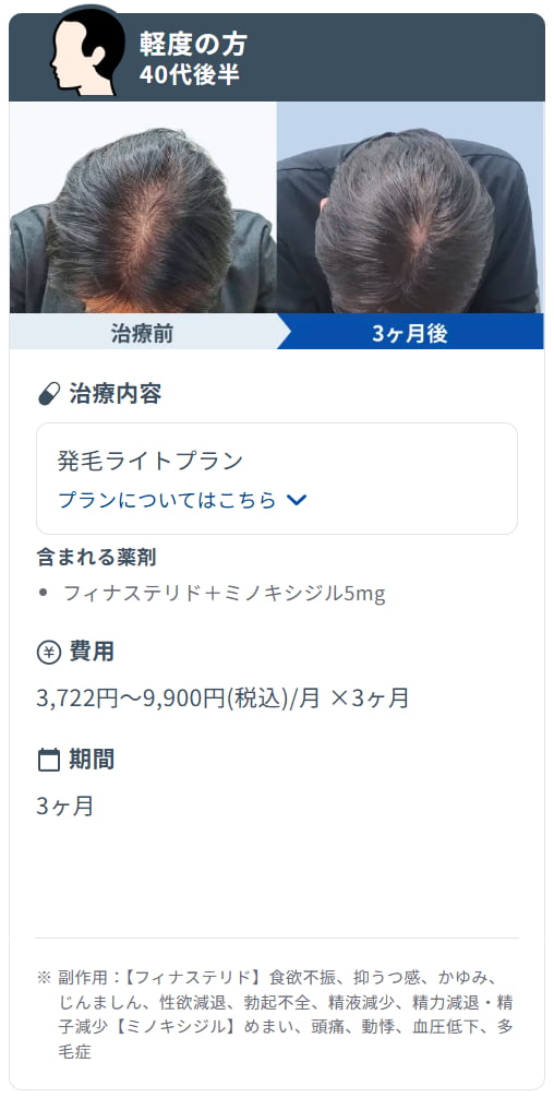 DMMオンラインクリニックのミノキシジル内服治療による症例写真(服用3ヶ月)。頭頂部付近のスジ型の薄毛の密度が改善し、地肌の露出が減っているビフォーアフターの様子。