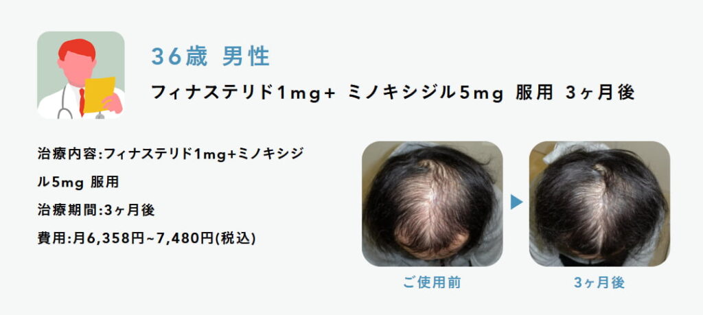 OopsHAIR(ウップスヘア)のミノキシジル内服薬を用いた発毛症例写真(服用3ヶ月)。生え際から頭頂部にかけてボリュームが増え、地肌が見える部分が減っているビフォーアフター比較画像。